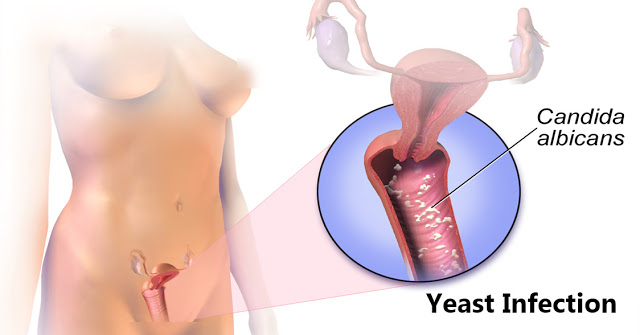 All Girls Should Know These Symptoms Of Vaginal Infection Which Many Are Not Aware Of! All Girls Should Know These Symptoms Of Vaginal Infection Which Many Are Not Aware Of!