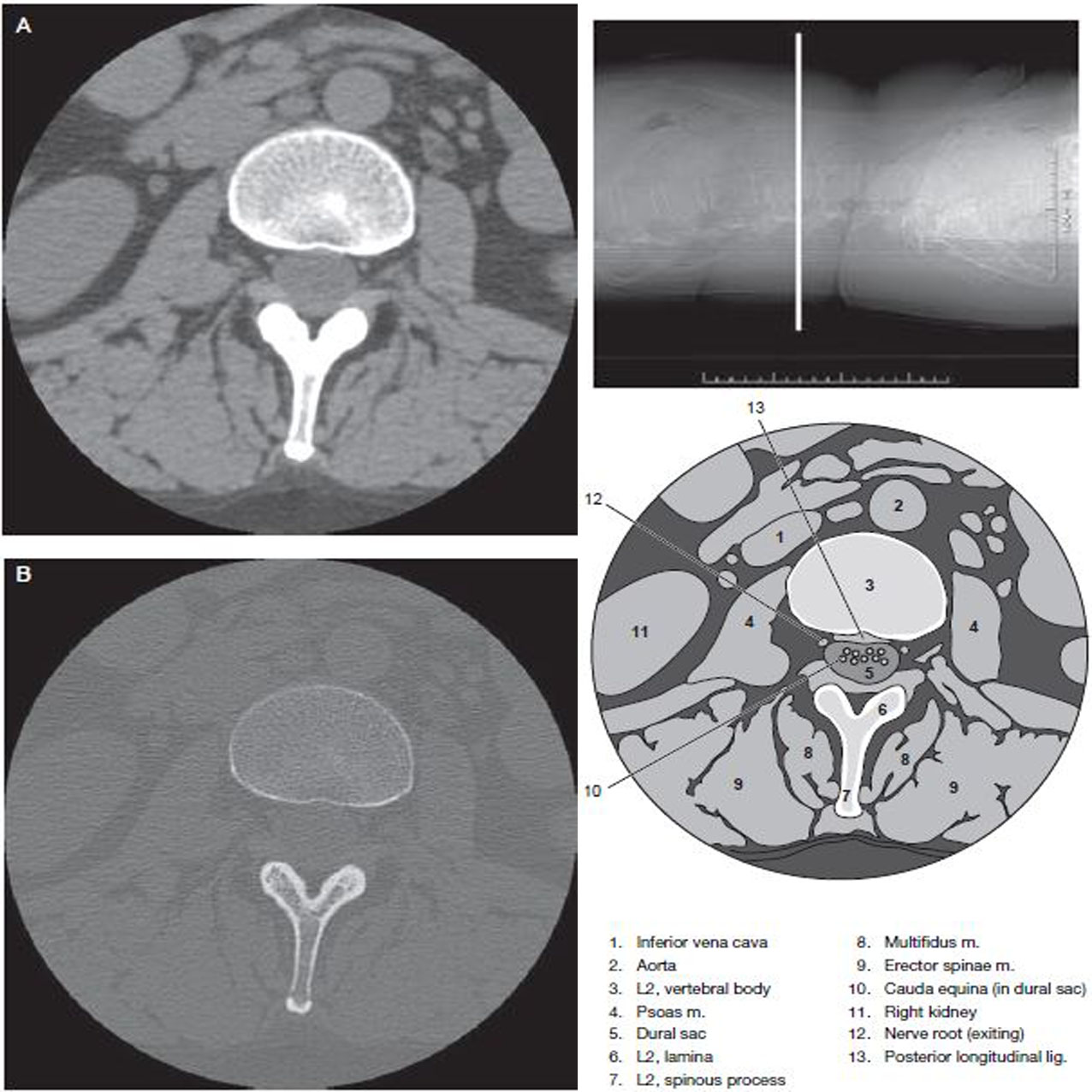 Lumbar Spine - Ct Scan - RadTechOnDuty