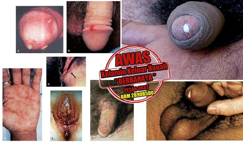 Obat Penyakit Kencing Nanah Pada Pria Obat Penyakit Kencing Nanah Pada Pria