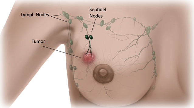 What do breast cancer lumps feel like What do breast cancer lumps feel like