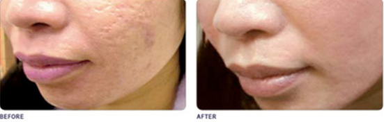 Plasma RX Skin Resurfing offered at Lumiere Dermatology Plasma RX Skin Resurfing offered at Lumiere Dermatology