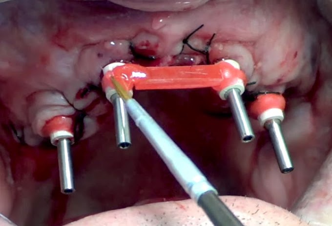 IMPLANTODONTIA: Sistema Arcsys - Reabilitação com próteses tipo protocolo mandíbula e maxila