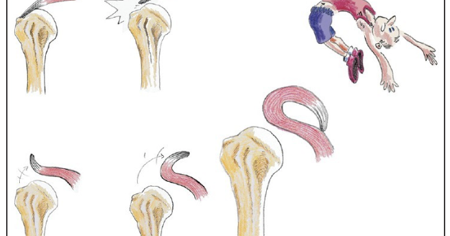 Medicina di un fungo di dita del piede