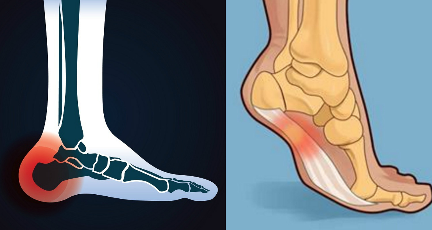 Does Your Heel Hurt In The Morning Or Whenever You