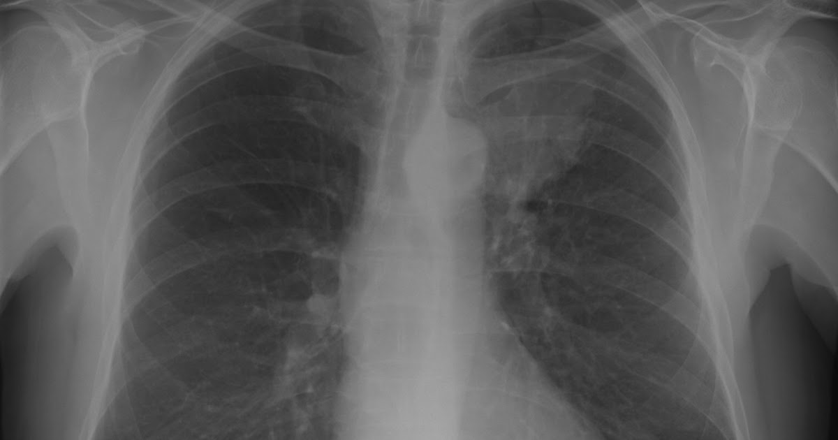 Breast Cancer limit Xrays or CT scans