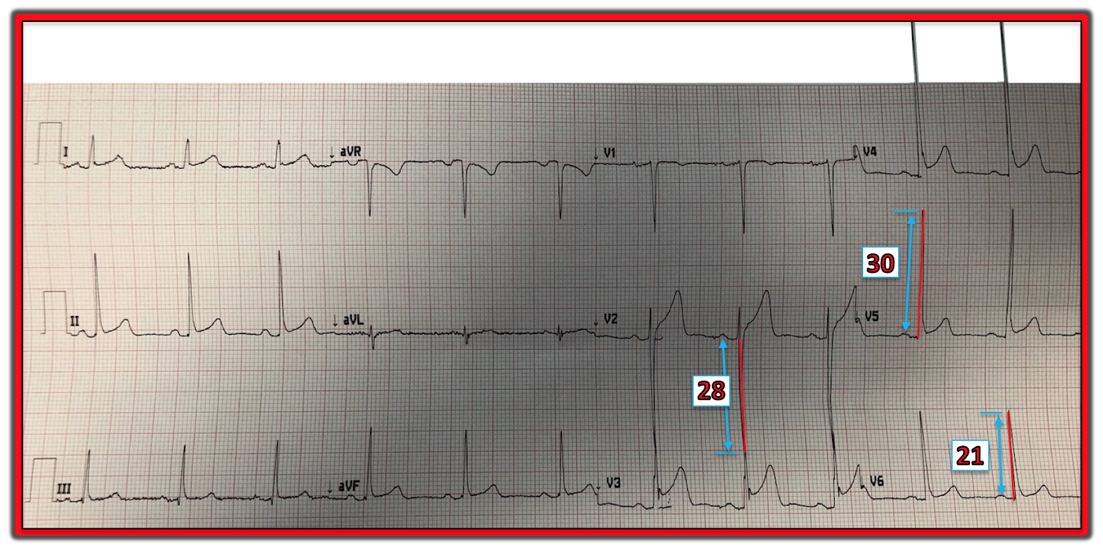 Dr. Smith's ECG Blog Is this terminal QRS distortion? Is there LVH?