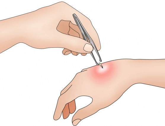 Natural Home Remedy for Wasp Sting Natural Home Remedy for Wasp Sting