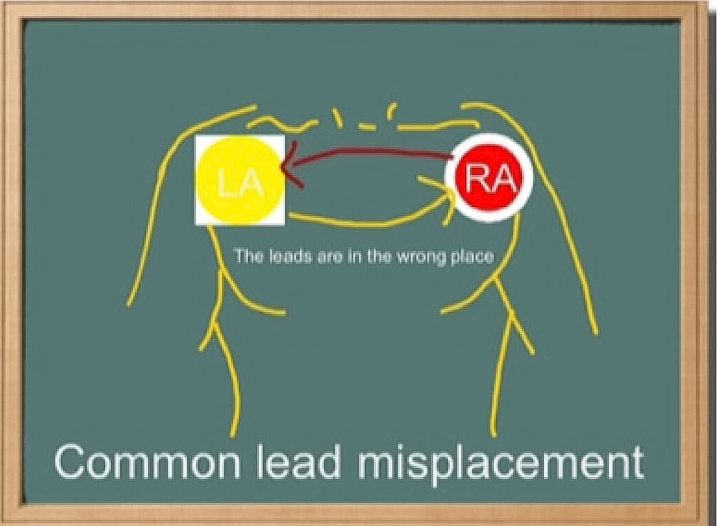 ECG Educator Blog : Dextrocardia 12 lead ekg limb diagram 