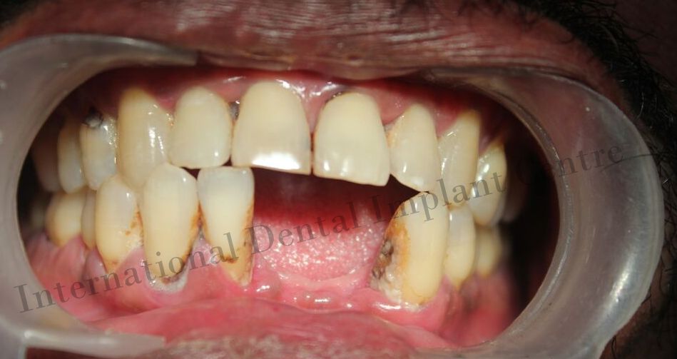 Best laser dental clinic Mugalivakkam Flapless Dental Implant with