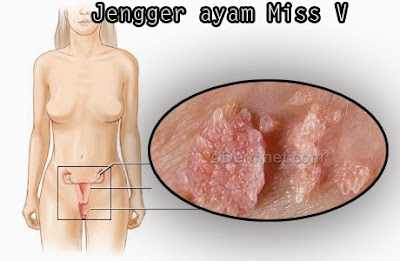 Image Kutil kemaluan mirip jengger ayam