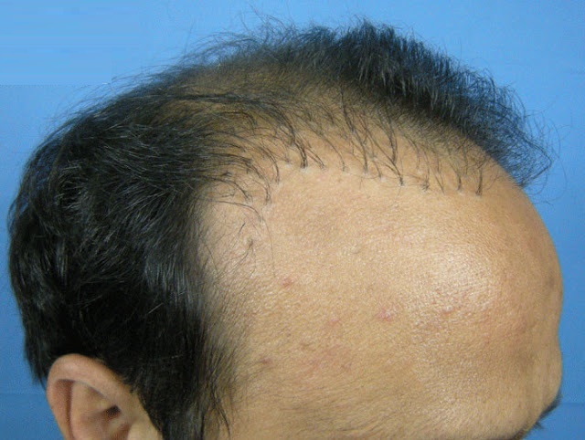 For Your Hairloss Solution How To Avoid A Bad Hair Transplantation