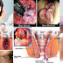 Obat Wasir (Hemoroid) Alami Dari Tumbuhan thumbnail