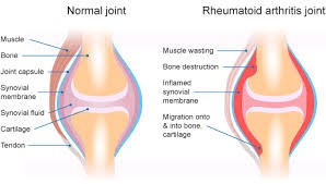 rheumatoid arthritis arthritic symptoms