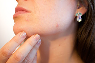 Quitar marcas de acne