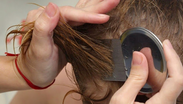 Cara Menghilangkan Kutu Rambut Tips Cara Menghilangkan Kutu Rambut