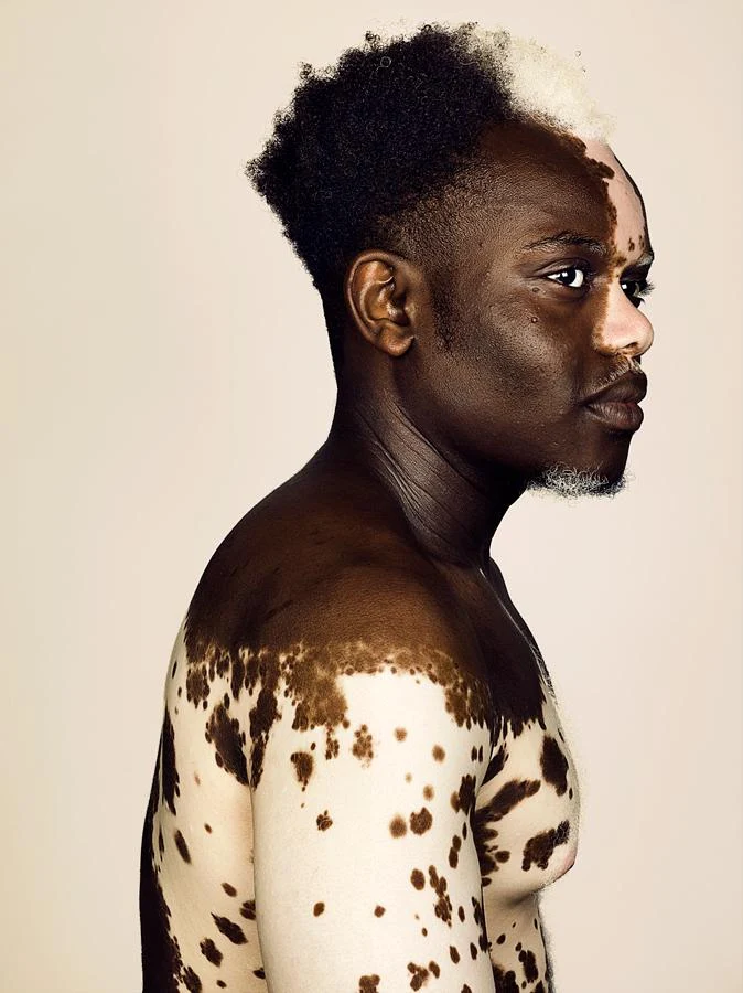 Personas con vitiligo-modelo Bashir Aziz