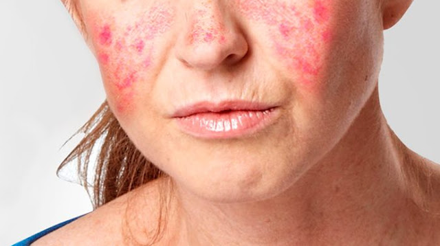 What causes lupus and symptoms ? Here define lupus you should know What causes lupus and symptoms ? Here define lupus you should know