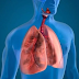 Treatment of Pneumonia that You Can Try