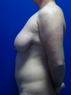 breast removal surgery photos