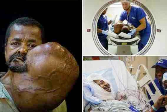 1 Man with tumour twice the size of his head has it removed after walking 3 days for help