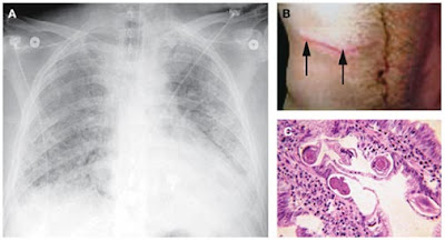 Infection Landscapes: Strongyloidiasis