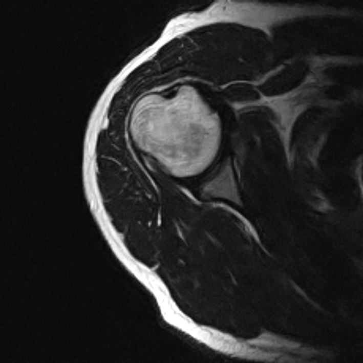 Pitching InjuryMRI Shoulder Sumer's Radiology Blog