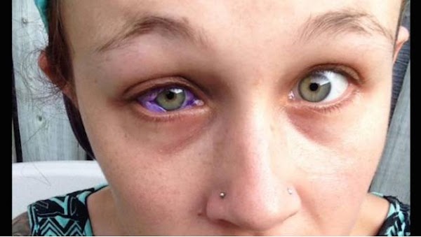 Un tatuaje ocular le arrebató la vista a esta modelo Un tatuaje ocular le arrebató la vista a esta modelo