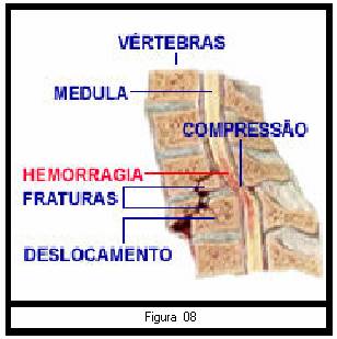 Por edema periférico lesão medular causado