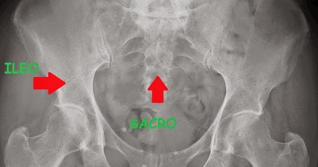 Fisioterapia E Fratture Del Bacino