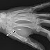 Empresas britânicas querem implantar microchips nos funcionários