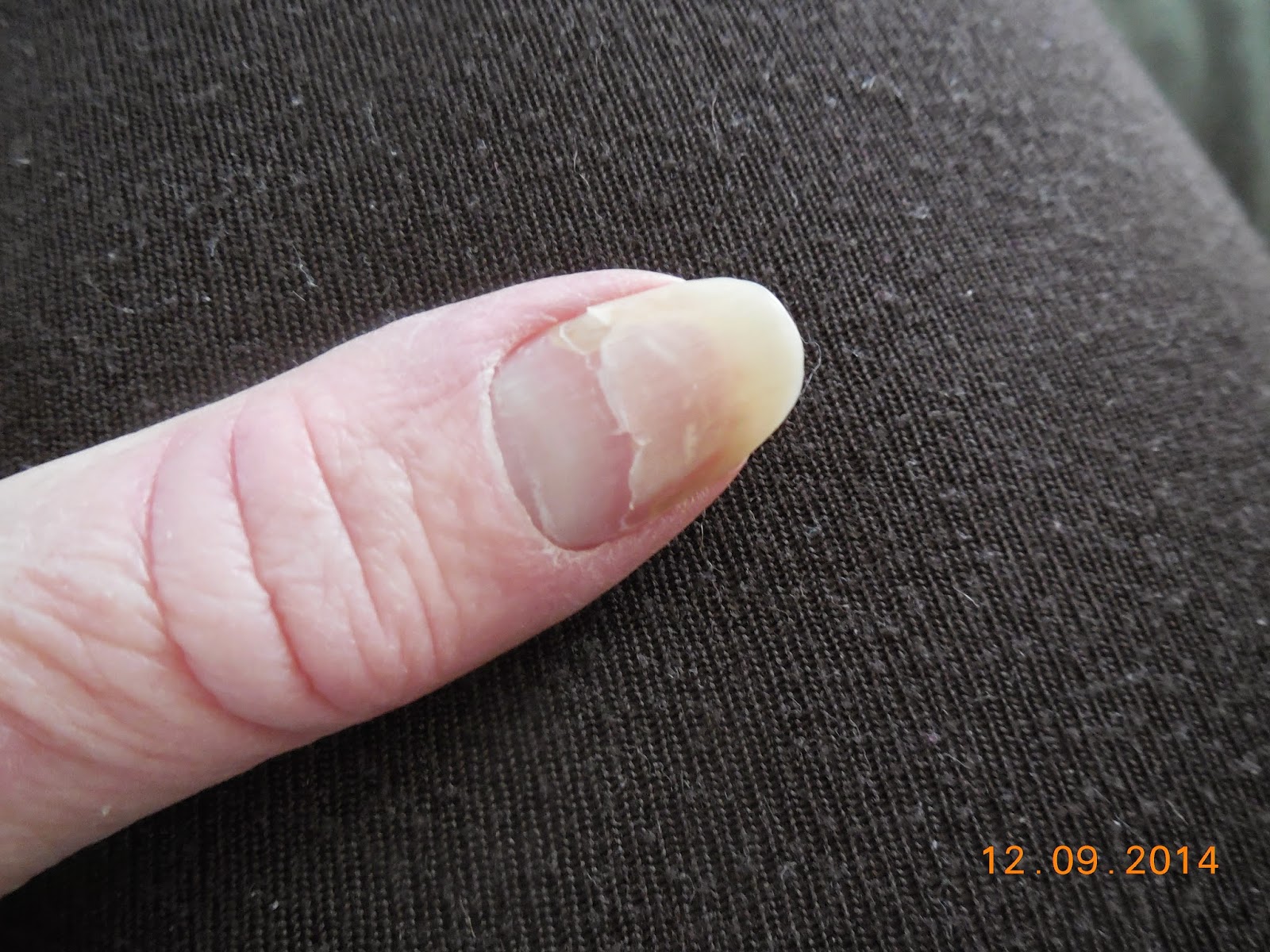 CHOCOLATE, One of My Many Addictions Chemo Side Effect Bad, Ugly