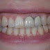 Cách làm trắng răng sứ hiệu quả