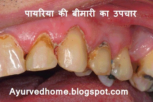 Pyria Disease Treatment in Hindi
