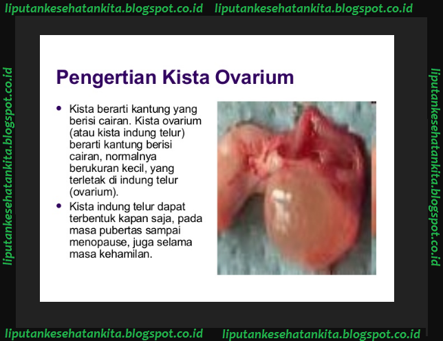 Jenis-Jenis Penyakit Kista Yang Mengganggu Rahim Wanita - Kharisma