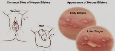 Harga Obat Herbal Penyakit Herpes Genital