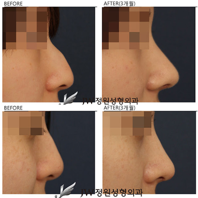 Phẫu thuật nâng mũi Hàn Quốc cho nam và nữ