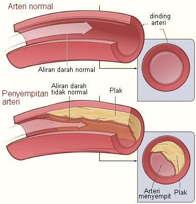 Arteri normal dan arteri menyempit