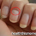 why white spots appear on nails