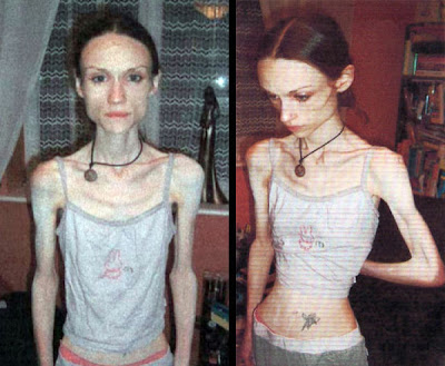 Covek Bez Maste Je Covek Bez Krila Anoreksija Anorexia