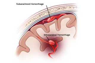 Manfaat Daun Karet Kebo Untuk Stroke gambar daun karet kebo, cara mengolah daun karet kebo, manfaat daun karet kebo bagi kesehatan, karet kebo untuk stroke, cara merebus daun karet kebo