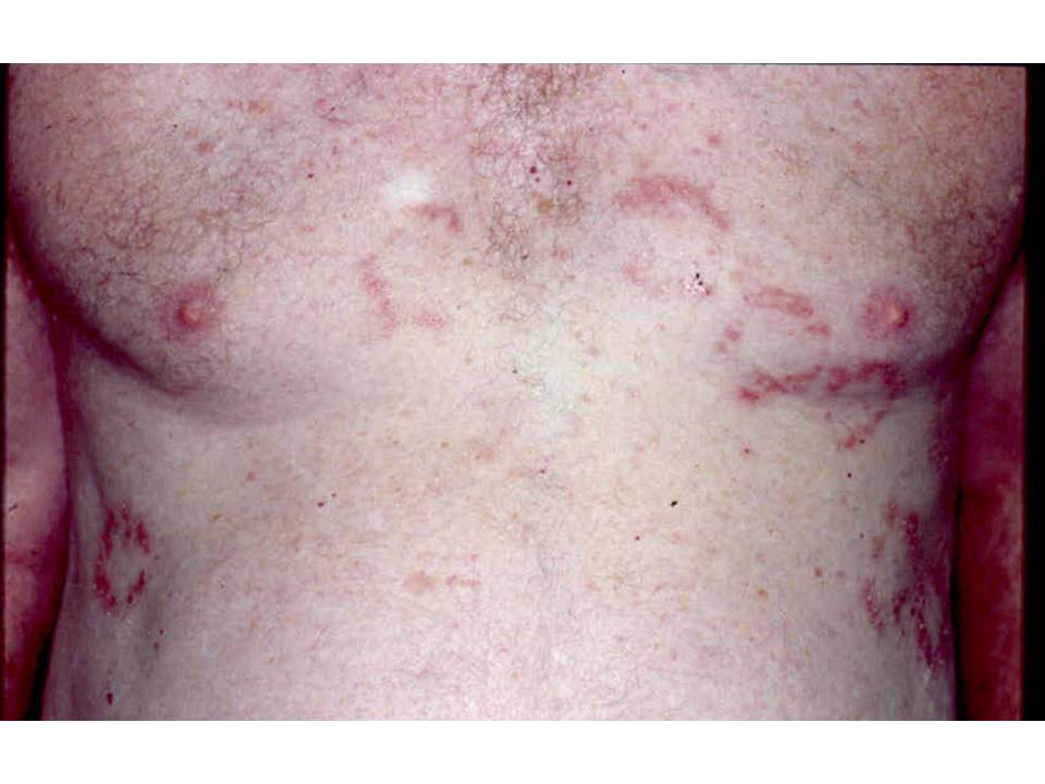 Consultations in Dermatology: The Groin Cracks Hailey Hailey Disease