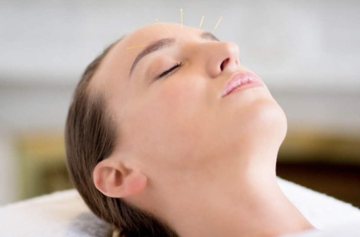 lifting acupuncture methode celine claret coquet avis test