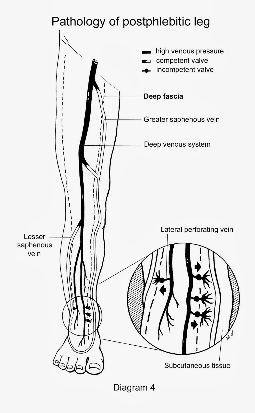 Removal of GSV and LSV of a moderate level distance runner with venous