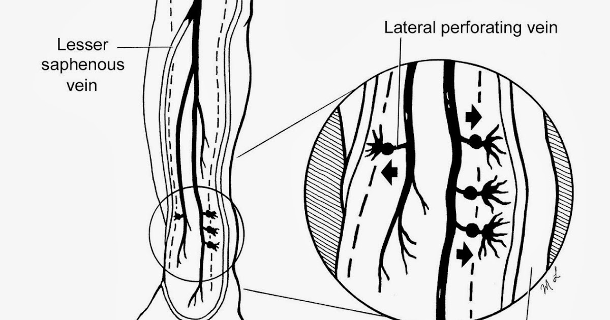 Removal of GSV and LSV of a moderate level distance runner with venous