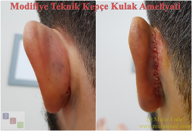 Ear plastic surgery in Istanbul - Modified technique otoplasty - Modified technique auriculoplasty - Correction of prominent ears in Istanbul  - Treatment of protruding ear - Bat ear - Obtrusive ears - Unfolded ears - Cosmetic ear surgery in Istanbul - Before and after photos for ear plastic surgery in Istanbul, Turkey - Protruding ear surgery - Conchomastoid technique for otoplasty