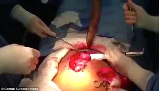 Lungfish Being Removed Inside Stomach Shown in Hospital Video Goes Viral