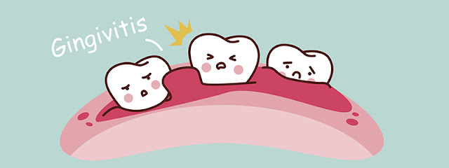8 Penyakit di dalam mulut yang sering berlaku ( Gingivitis 