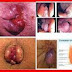 Obat Bebas Wasir Tanpa Operasi thumbnail
