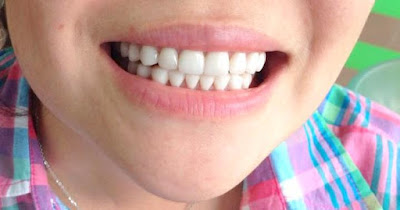 Tẩy trắng răng cho trẻ như thế nào?