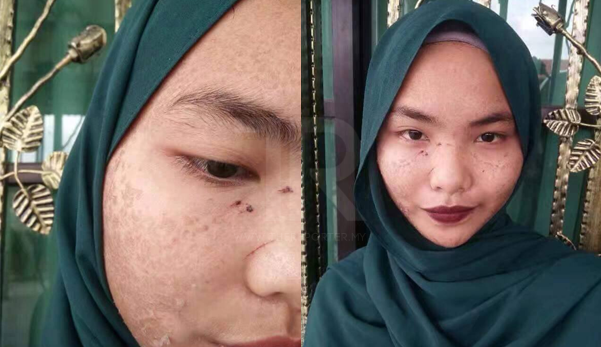 "Saya menyesal guna produk ni" - Kulit muka wanita ini bersisik lepas guna produk kecantikan